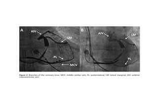 technical aspect of Left ventricular lead placement for CRT | PPTX