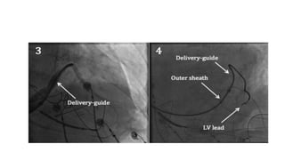 technical aspect of Left ventricular lead placement for CRT | PPTX