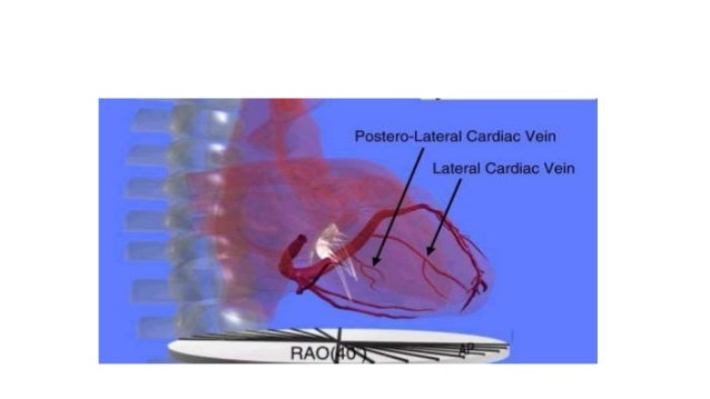 technical aspect of Left ventricular lead placement for CRT