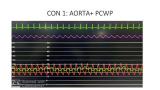 CON 1: AORTA+ PCWP
