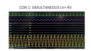 CON 1: SIMULTANEOUS LV+ RV