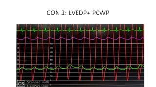 CON 2: LVEDP+ PCWP
