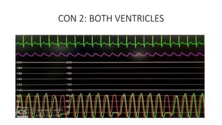 CON 2: BOTH VENTRICLES