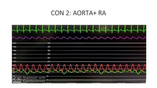 CON 2: AORTA+ RA