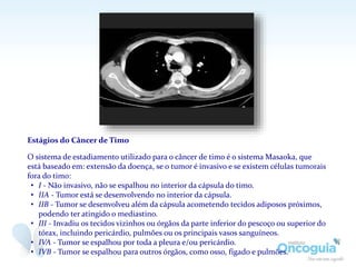 Estágios do Câncer de Timo
O sistema de estadiamento utilizado para o câncer de timo é o sistema Masaoka, que
está baseado em: extensão da doença, se o tumor é invasivo e se existem células tumorais
fora do timo:
• I - Não invasivo, não se espalhou no interior da cápsula do timo.
• IIA - Tumor está se desenvolvendo no interior da cápsula.
• IIB - Tumor se desenvolveu além da cápsula acometendo tecidos adiposos próximos,
podendo ter atingido o mediastino.
• III - Invadiu os tecidos vizinhos ou órgãos da parte inferior do pescoço ou superior do
tórax, incluindo pericárdio, pulmões ou os principais vasos sanguíneos.
• IVA - Tumor se espalhou por toda a pleura e/ou pericárdio.
• IVB - Tumor se espalhou para outros órgãos, como osso, fígado e pulmões.
 
