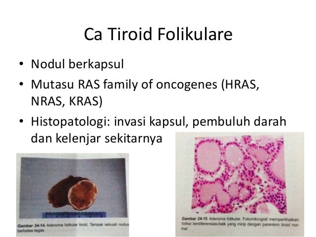 Ca tiroid