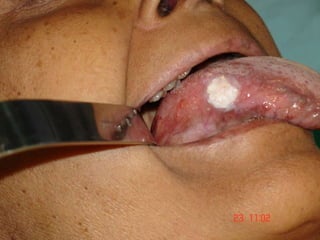 Oral Cancer Screening 