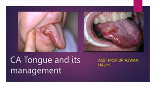 CA Tongue and its
management
ASST PROF DR AZWAN
HALIM
 