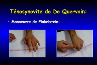 Ténosynovite de De Quervain:Ténosynovite de De Quervain:
• Manoeuvre de Finkelstein:Manoeuvre de Finkelstein:
 