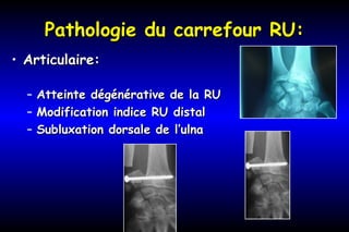 Pathologie du carrefour RU:Pathologie du carrefour RU:
• Articulaire:Articulaire:
– Atteinte dégénérative de la RUAtteinte dégénérative de la RU
– Modification indice RU distalModification indice RU distal
– Subluxation dorsale de l’ulnaSubluxation dorsale de l’ulna
 