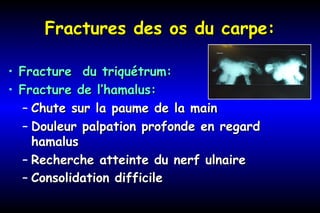Fractures des os du carpe:Fractures des os du carpe:
• Fracture du triquétrum:Fracture du triquétrum:
• Fracture de l’hamalus:Fracture de l’hamalus:
– Chute sur la paume de la mainChute sur la paume de la main
– Douleur palpation profonde en regardDouleur palpation profonde en regard
hamalushamalus
– Recherche atteinte du nerf ulnaireRecherche atteinte du nerf ulnaire
– Consolidation difficileConsolidation difficile
 