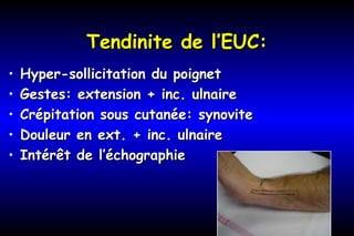 Tendinite de l’EUC:Tendinite de l’EUC:
• Hyper-sollicitation du poignetHyper-sollicitation du poignet
• Gestes: extension + inc. ulnaireGestes: extension + inc. ulnaire
• Crépitation sous cutanée: synoviteCrépitation sous cutanée: synovite
• Douleur en ext. + inc. ulnaireDouleur en ext. + inc. ulnaire
• Intérêt de l’échographieIntérêt de l’échographie
 