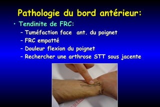 Pathologie du bord antérieur:Pathologie du bord antérieur:
• Tendinite de FRC:Tendinite de FRC:
– Tuméfaction face ant. du poignetTuméfaction face ant. du poignet
– FRC empattéFRC empatté
– Douleur flexion du poignetDouleur flexion du poignet
– Rechercher une arthrose STT sous jacenteRechercher une arthrose STT sous jacente
 