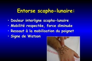 Entorse scapho-lunaire:Entorse scapho-lunaire:
• Douleur interligne scapho-lunaireDouleur interligne scapho-lunaire
• Mobilité respectée, force diminuéeMobilité respectée, force diminuée
• Ressaut à la mobilisation du poignetRessaut à la mobilisation du poignet
• Signe de WatsonSigne de Watson
 