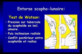 EntorseEntorse scaphoscapho--lunaire:lunaire:
Test de Watson:Test de Watson:
•• Pression sur tuberculePression sur tubercule
du scaphoïde endu scaphoïde en inclincl..
ulnaire.ulnaire.
•• Puis inclinaison radialePuis inclinaison radiale
•• Conflit postérieur entreConflit postérieur entre
scaphoïde et radiusscaphoïde et radius
 