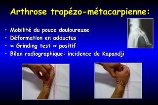 Arthrose trapézo-métacarpienne:Arthrose trapézo-métacarpienne:
• Mobilité du pouce douloureuseMobilité du pouce douloureuse
• Déformation en adductusDéformation en adductus
• « Grinding test » positif« Grinding test » positif
• Bilan radiographique: incidence de KapandjiBilan radiographique: incidence de Kapandji
 