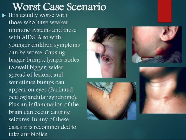 antibiotics for cat scratch disease
