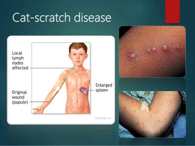Cat Scratch Fever Rash Pictures Cat Scratch Fever Rash Pictures