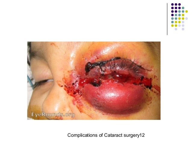 Cataract surgery complications