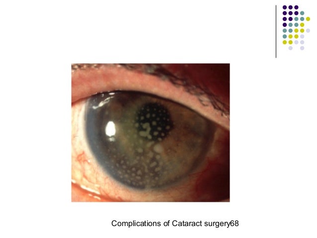 Cat Eye Removal Complications Cat Eye Removal Complications