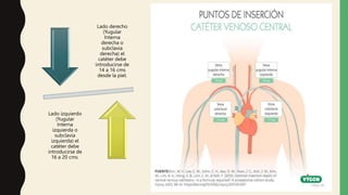 Lado derecho
(Yugular
Interna
derecha o
subclavia
derecha) el
catéter debe
introducirse de
14 a 16 cms
desde la piel.
Lado izquierdo
(Yugular
Interna
izquierda o
subclavia
izquierda) el
catéter debe
introducirse de
16 a 20 cms.
 