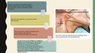 Posición del paciente: decúbito supino,
cabeza rotada hacia el lado contralateral
de la punción, brazos colocados al lado
del cuerpo.
Posición del operador: se colocará al lado
del paciente.
Sitio de punción: ángulo formado por el
borde exterior del músculo
esternocleidomastoideo y la clavícula.
Se punciona el sitio elegido y la aguja se
dirige en un ángulo de 45° con el plano
sagital y de 15° por delante del plano
coronal, en dirección a la primera
articulación condroesternal ipsilateral, la
vena es detectada habitualmente entre 1 a
1,5 cm de la piel. Se debe mantener
aspiración continua hasta obtener fl ujo de
sangre venosa.
 