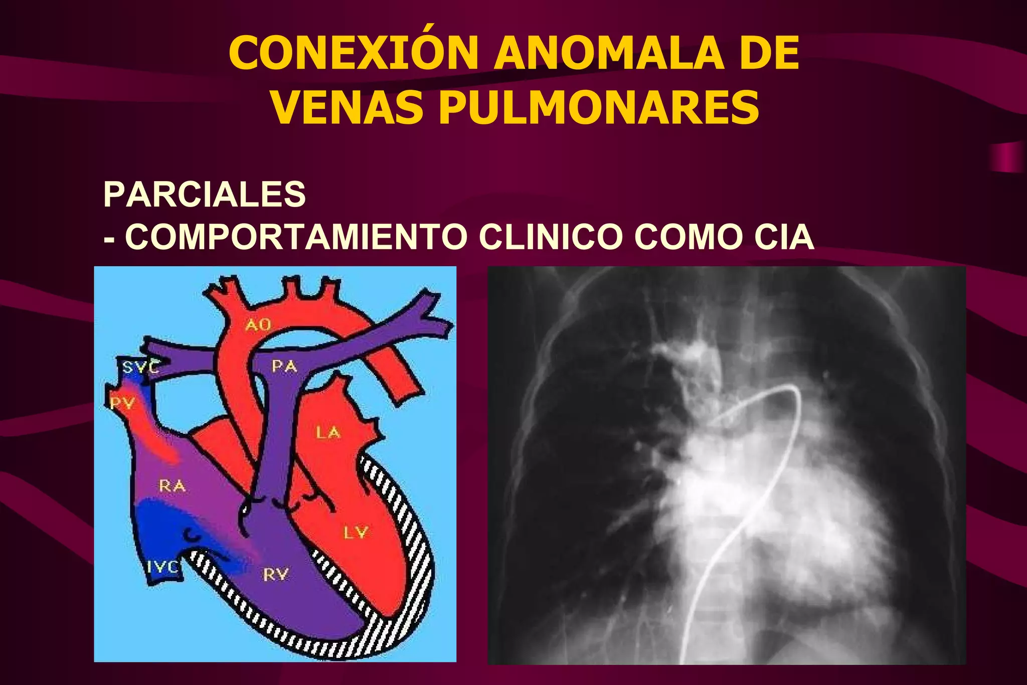 Conexión Anómala de Venas Pulmonares | PPT