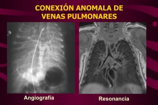 Conexión Anómala de Venas Pulmonares | PPT