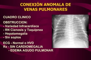 Conexión Anómala de Venas Pulmonares | PPT