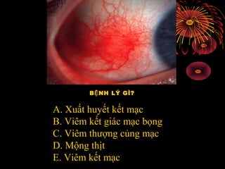 B NH LÝ GÌ?Ệ
A. Xuất huyết kết mạc
B. Viêm kết giác mạc bọng
C. Viêm thượng củng mạc
D. Mộng thịt
E. Viêm kết mạc
 