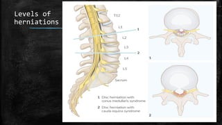 Levels of
herniations
 