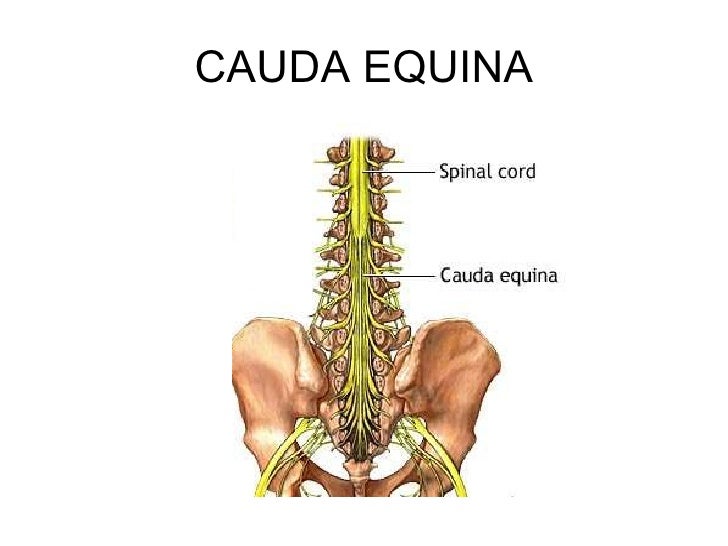 Cauda equina syndrome
