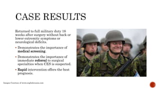 Cauda equina syndrome 