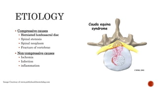 Cauda equina syndrome 