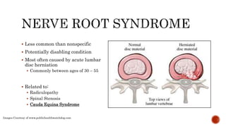 Cauda equina syndrome 