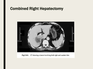 Combined Right Hepatectomy
 