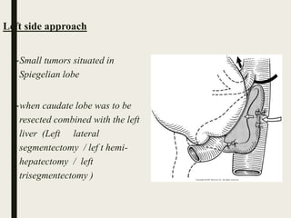 Left side approach
–Small tumors situated in
Spiegelian lobe
–when caudate lobe was to be
resected combined with the left
liver (Left lateral
segmentectomy / lef t hemi-
hepatectomy / left
trisegmentectomy )
 