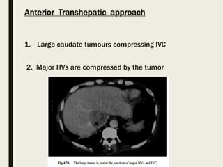 Anterior Transhepatic approach
1. Large caudate tumours compressing IVC
2. Major HVs are compressed by the tumor
 