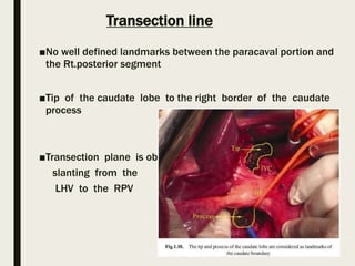 Transection line
■No well defined landmarks between the paracaval portion and
the Rt.posterior segment
■Tip of the caudate lobe to the right border of the caudate
process
■Transection plane is oblique
slanting from the
LHV to the RPV
 
