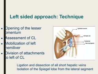 Left sided approach: Technique
● Opening of the lesser
omentum
● Assessment of CL
● Mobilization of left
hemiliver
● Division of attachments
to left of CL
Ligation and dissection of all short hepatic veins
Isolation of the Spiegel lobe from the lateral segment
 