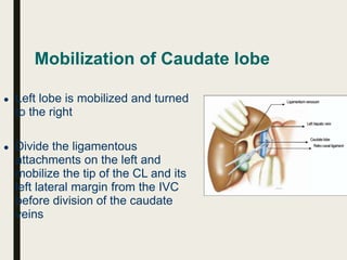 Mobilization of Caudate lobe
● Left lobe is mobilized and turned
to the right
● Divide the ligamentous
attachments on the left and
mobilize the tip of the CL and its
left lateral margin from the IVC
before division of the caudate
veins
 