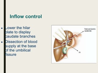 Inflow control
● Lower the hilar
plate to display
caudate branches
● Dissection of blood
supply at the base
of the umbilical
fissure
 