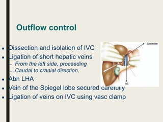 Outflow control
● Dissection and isolation of IVC
● Ligation of short hepatic veins
– From the left side, proceeding
– Caudal to cranial direction.
● Abn LHA
● Vein of the Spiegel lobe secured carefully
● Ligation of veins on IVC using vasc clamp
 