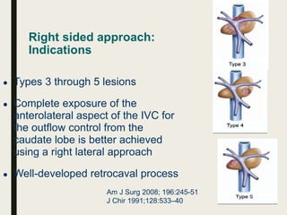 Right sided approach:
Indications
● Types 3 through 5 lesions
● Complete exposure of the
anterolateral aspect of the IVC for
the outflow control from the
caudate lobe is better achieved
using a right lateral approach
● Well-developed retrocaval process
Am J Surg 2008; 196:245-51
J Chir 1991;128:533–40
 