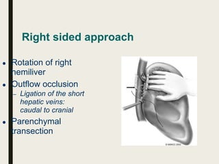 Right sided approach
● Rotation of right
hemiliver
● Outflow occlusion
– Ligation of the short
hepatic veins:
caudal to cranial
● Parenchymal
transection
 