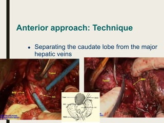 Anterior approach: Technique
● Separating the caudate lobe from the major
hepatic veins
 