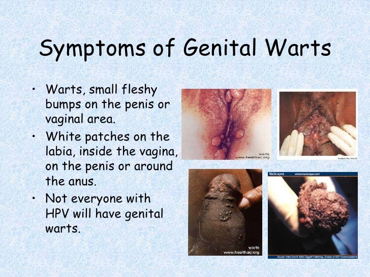 Genital Warts | STD Symptoms, Treatment and Removal