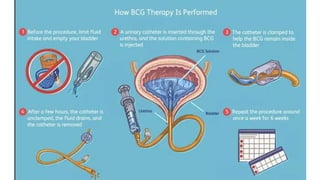 Ca Urinary Bladder anatomy to management | PPTX