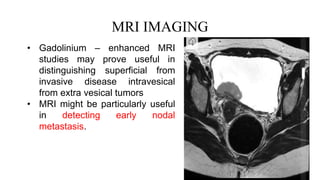 MRI IMAGING
• Gadolinium – enhanced MRI
studies may prove useful in
distinguishing superficial from
invasive disease intravesical
from extra vesical tumors
• MRI might be particularly useful
in detecting early nodal
metastasis.
 