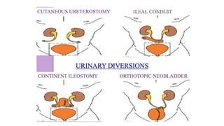 Diagram showing boundaries of pelvic
lymphadenectomy
 